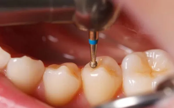 Cosmetic Filling