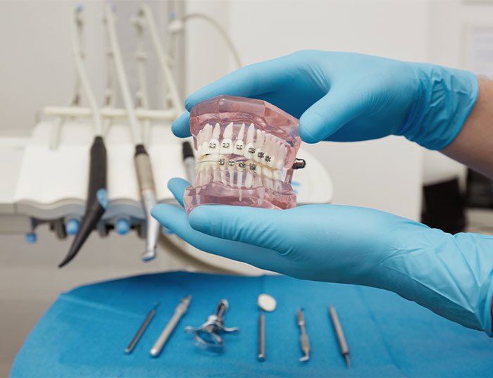 How Much Do Aligners Cost in Noida?