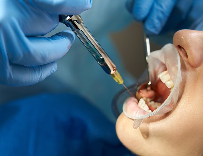 Is Root Canal Treatment Painful?