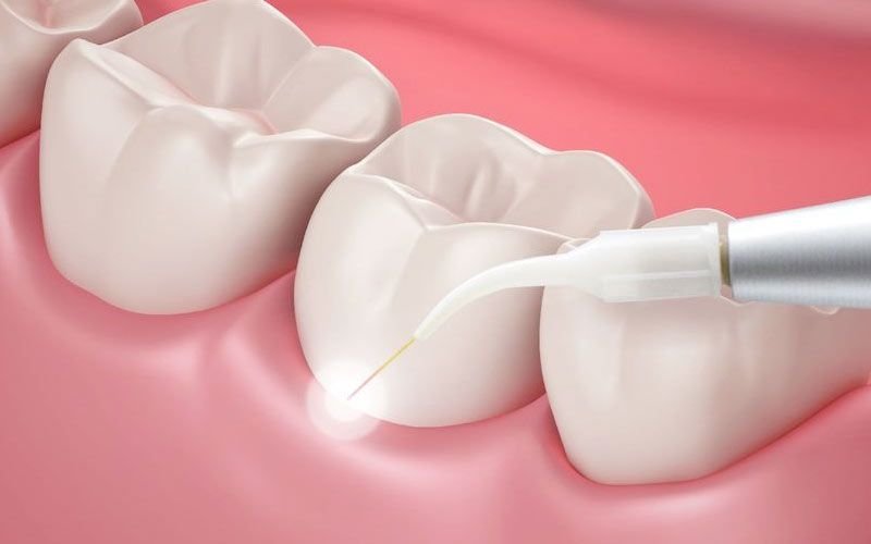 Laser Dentistry
