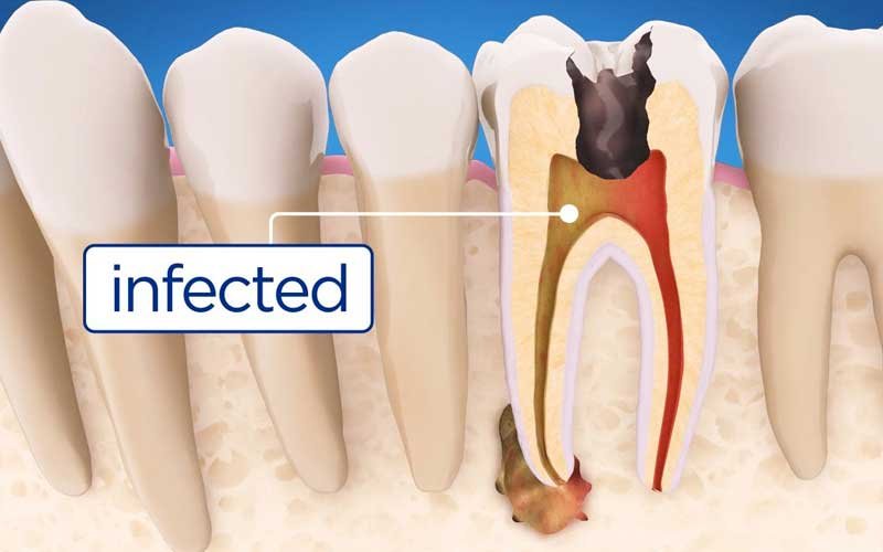 Root Canal Treatment