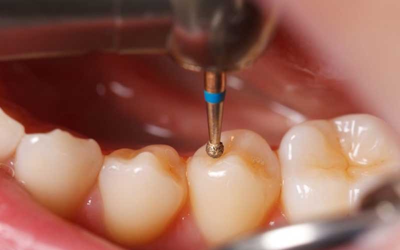 Cosmetic Filling