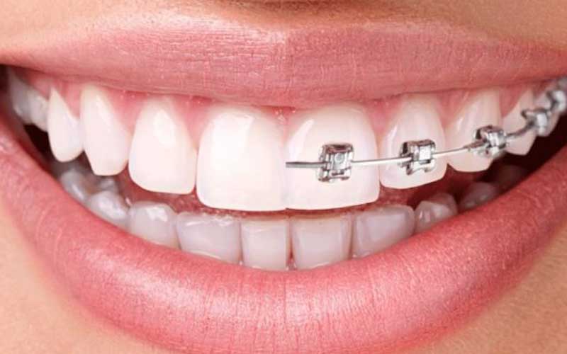 Orthodontic Treatment & Aligners