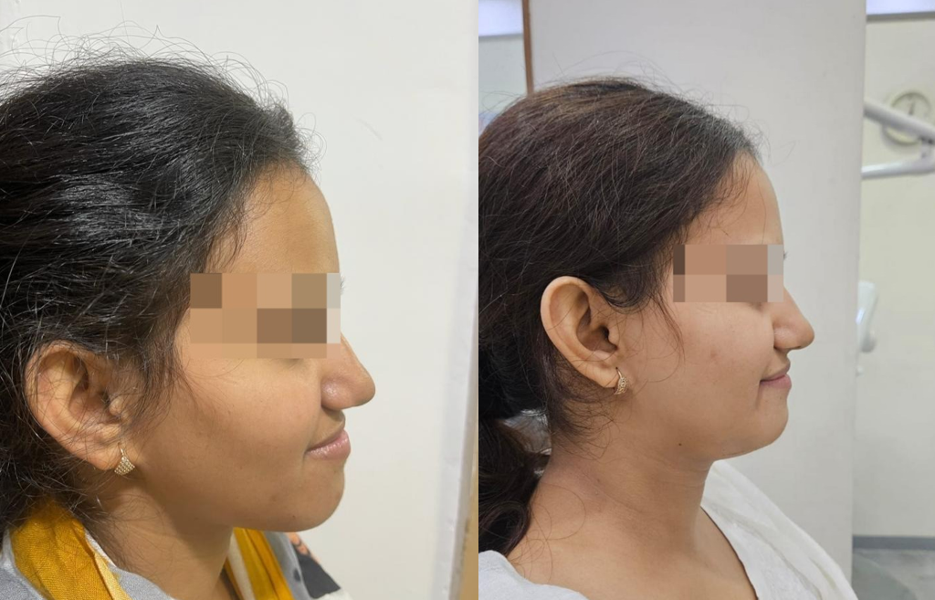 Orthognathic Surgeries