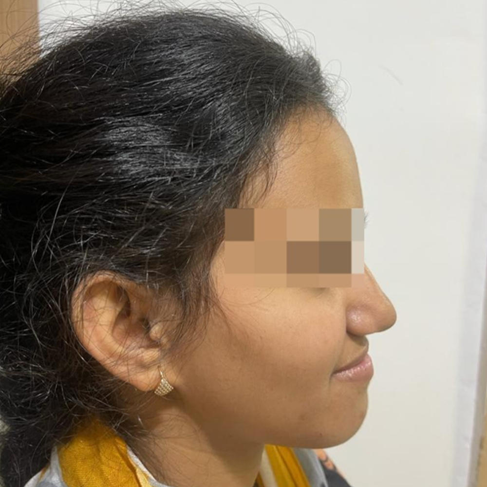 Orthognathic Surgeries