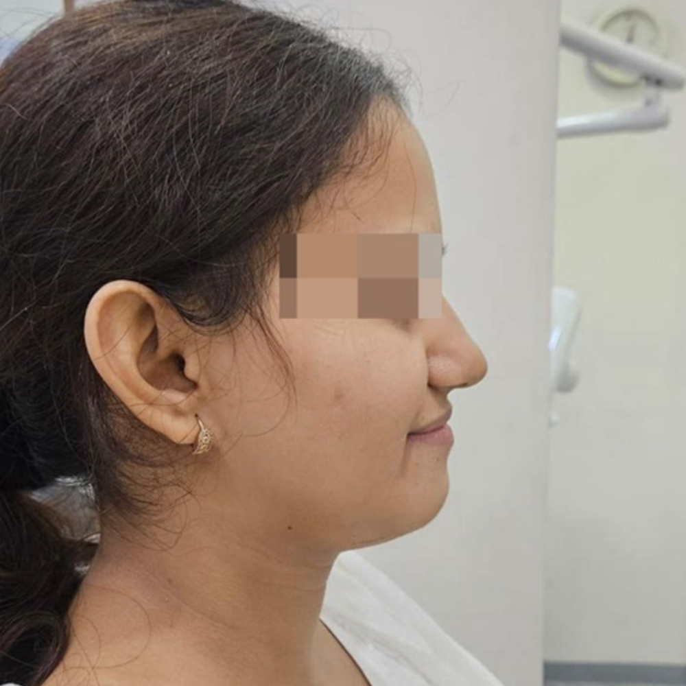 Orthognathic Surgeries