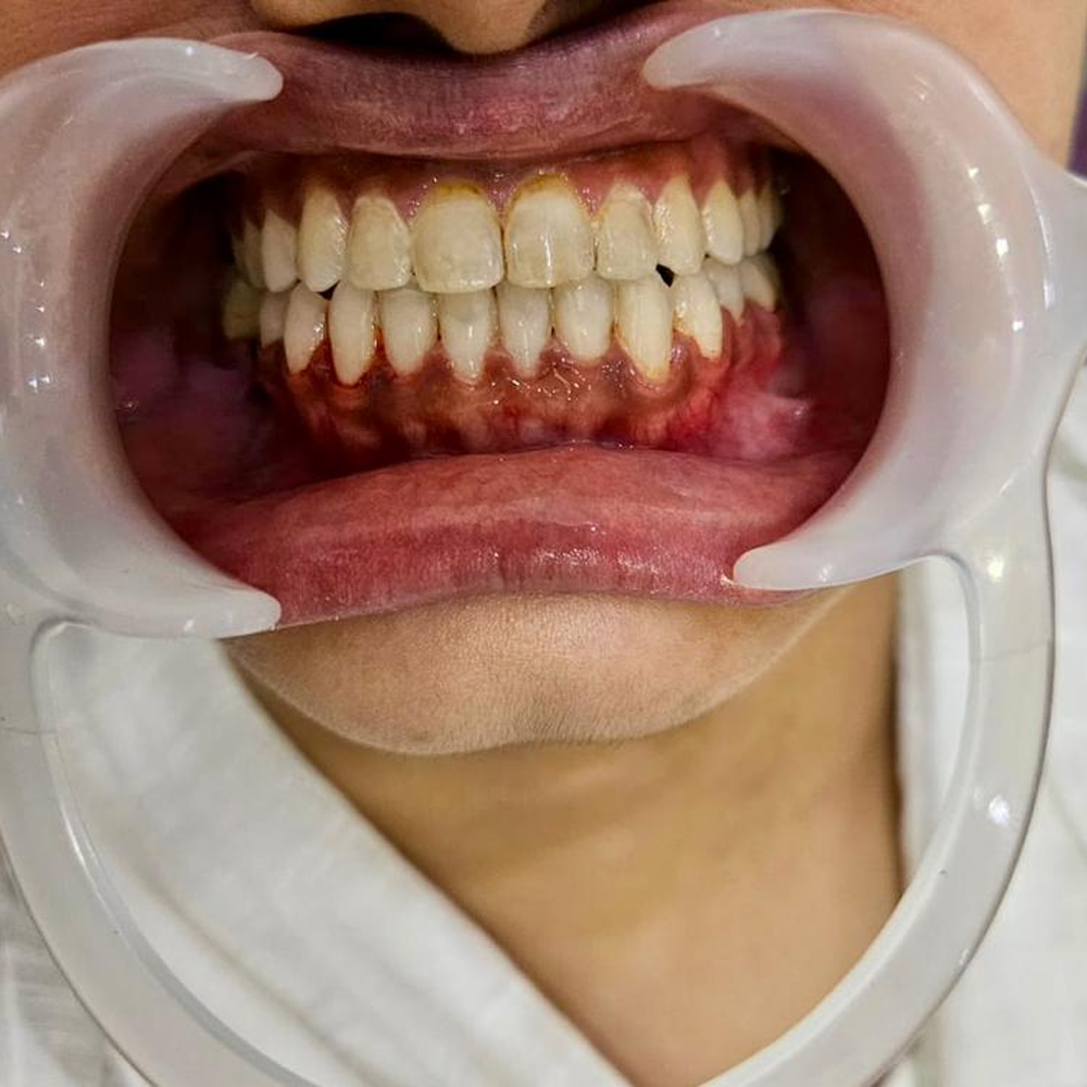 Orthognathic Surgeries