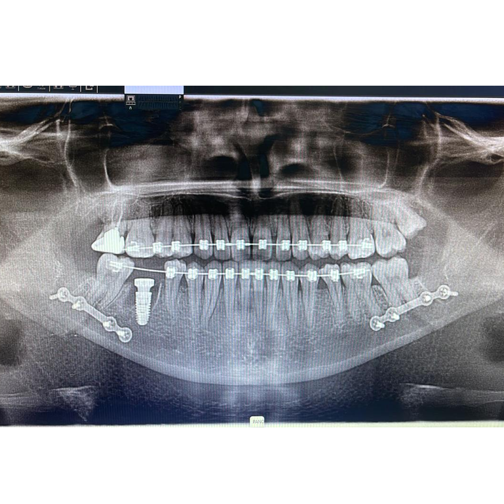 Orthognathic Surgeries