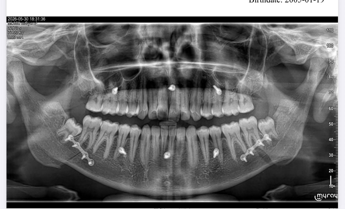 Jaw Corrective Surgery (Orthognathic)
