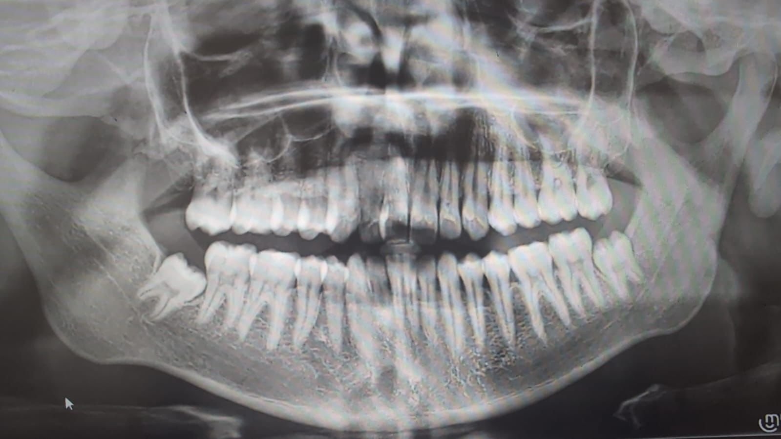 Jaw Corrective Surgery (Orthognathic)